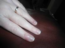 Painful, lifting nails