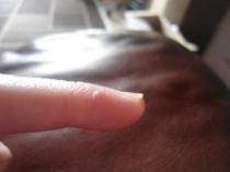 Painful, lifting nails