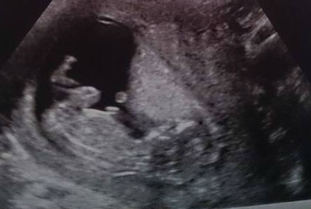 September 2014 - where we enjoy happy scans and a healthy 2nd trimester