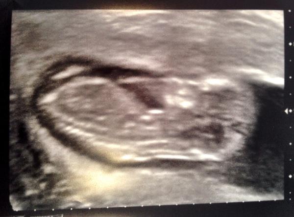 September 2014 - where we enjoy happy scans and a healthy 2nd trimester