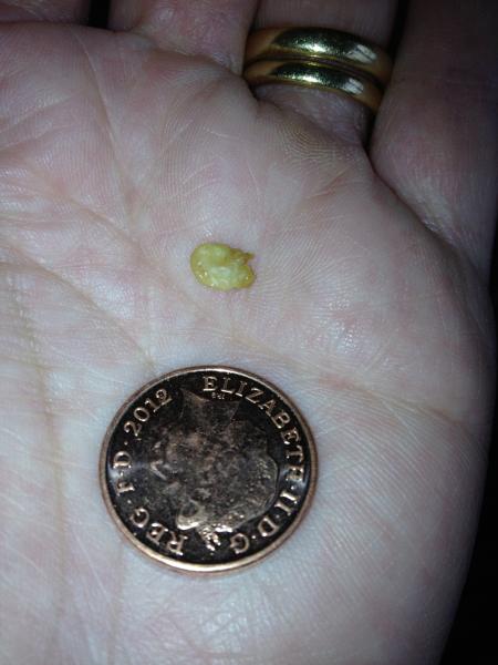 Tonsil stones, neck pain