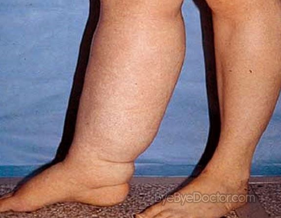 Severe Swelling In Pregnancy