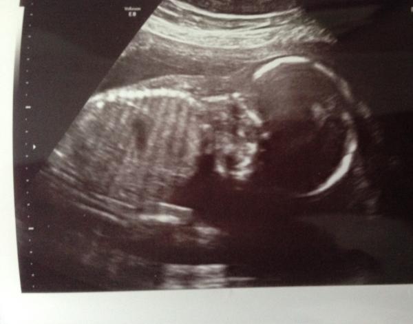 August 2014: growing bumps and 20 week scans!!!