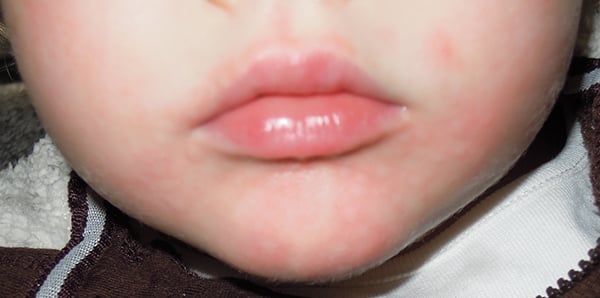 Mild reaction to nuts