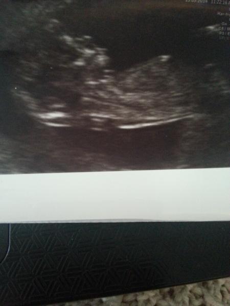 September 2014 - where we enjoy happy scans and a healthy 2nd trimester