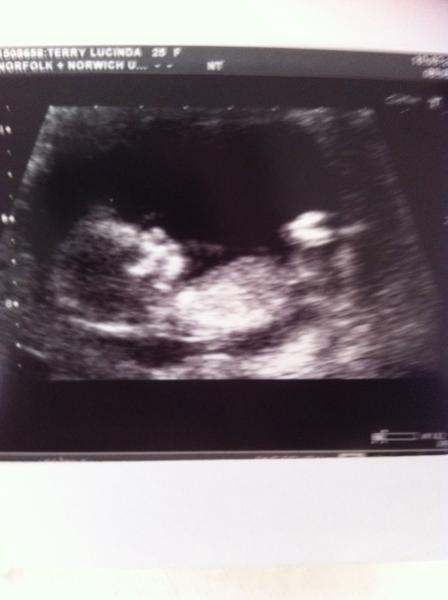 September 2014 - where we enjoy happy scans and a healthy 2nd trimester