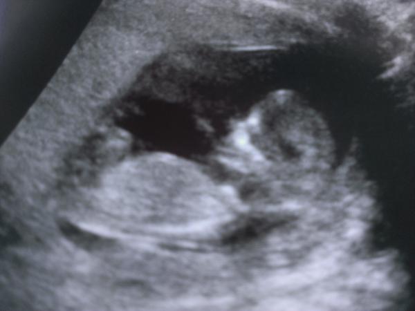 September 2014 - where we enjoy happy scans and a healthy 2nd trimester