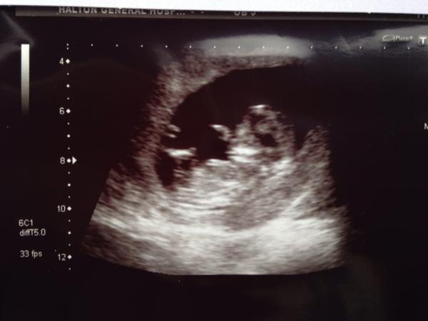 September 2014 - where we enjoy happy scans and a healthy 2nd trimester