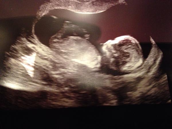 September 2014 - where we enjoy happy scans and a healthy 2nd trimester