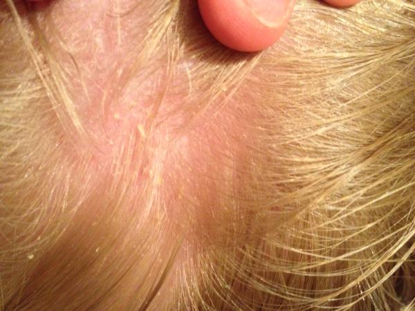 Are these lice eggs?