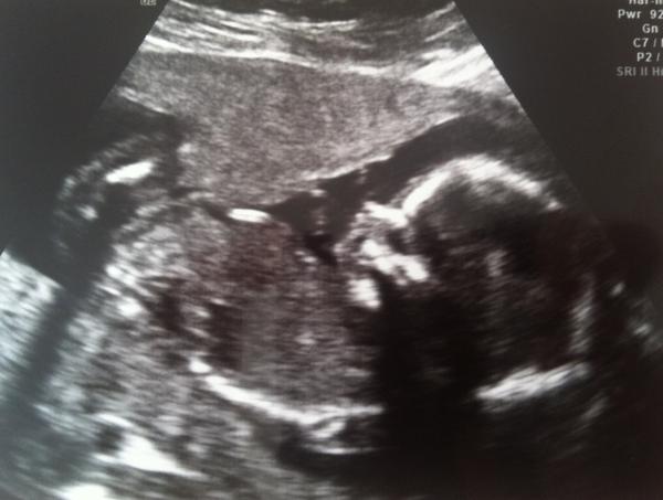 August 2014: growing bumps and 20 week scans!!!