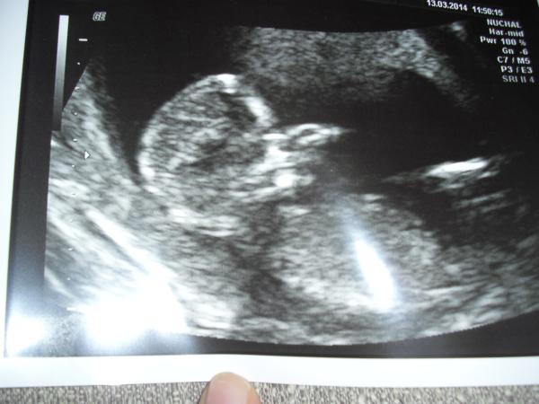 September 2014 - where we enjoy happy scans and a healthy 2nd trimester