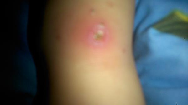 Are these chicken pox?