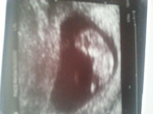 September 2014 - where we enjoy happy scans and a healthy 2nd trimester