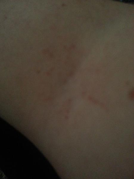 reoccurring rash