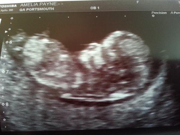 September 2014 - where we enjoy happy scans and a healthy 2nd trimester
