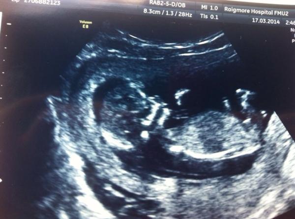 Nub theory - am I having a boy or a girl?