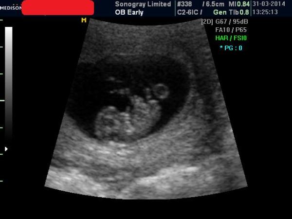 November 2014 Thread 2: Springing through the first trimester!