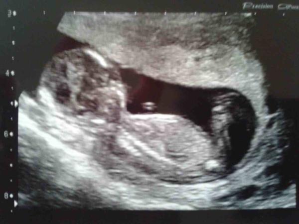 September 2014 - where we enjoy happy scans and a healthy 2nd trimester