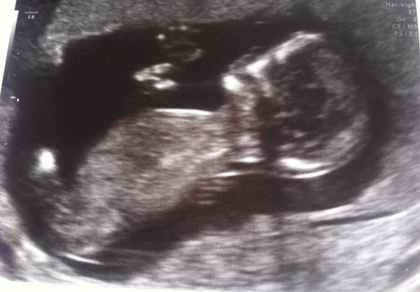 September 2014 - where we enjoy happy scans and a healthy 2nd trimester