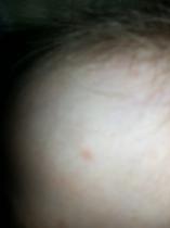 Are these chicken pox?