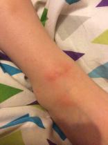 Ideas on rash please
