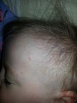 Are these chicken pox?