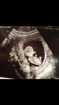 Guess the gender! 12 weeks.