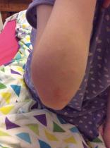 Ideas on rash please