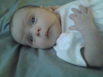 New born Baby with a swollen forehead