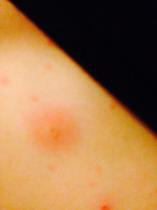 Chicken pox advice, is this infected?