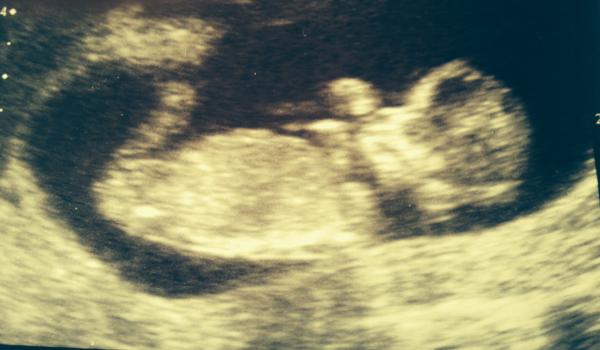 Boy or Girl??