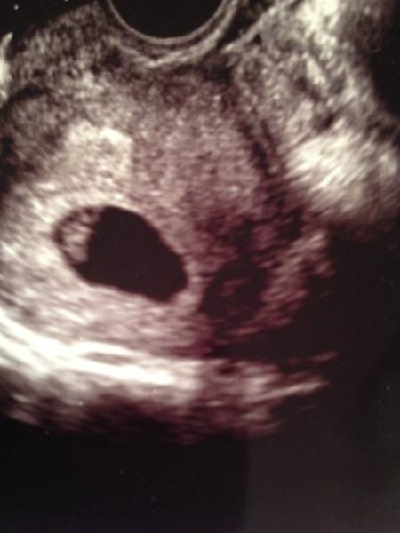 12 week scan looks like twins but sonographer didn't pick up on it?????