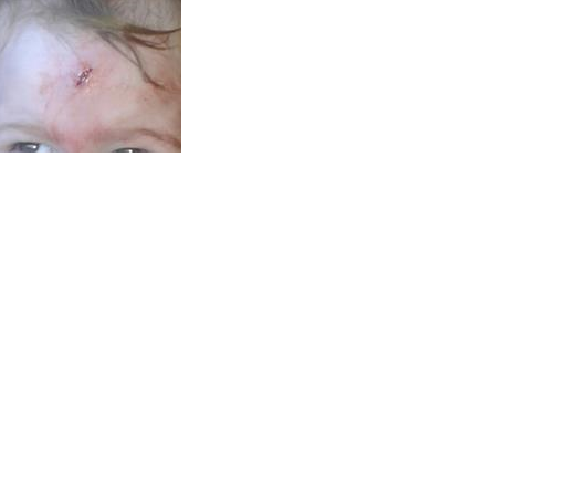 scar on daughter's forehead...should have been stitched and not glued!