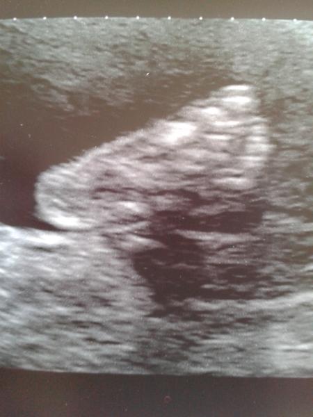 September 2014 - Holding hands and 20 week scans...