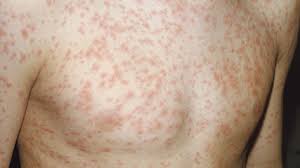 Illnesses similar to Measles?