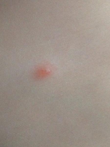 Is this chickenpox?