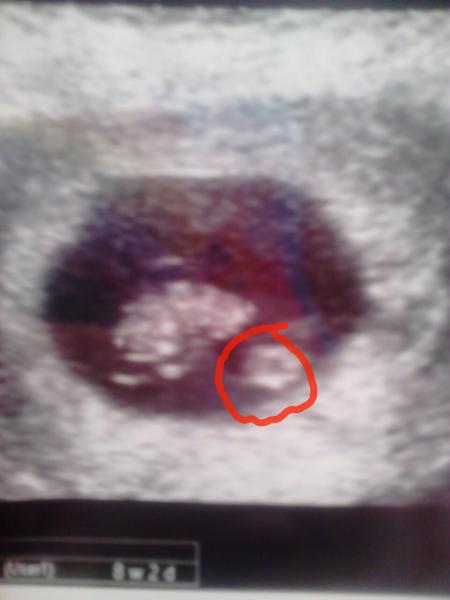 Strange blob on scan..