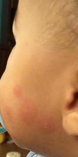 10month old with unknown red blisters
