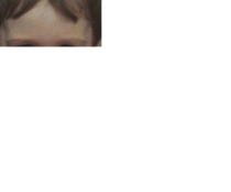 scar on daughter's forehead...should have been stitched and not glued!