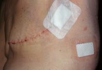 Zombie's  journey with breast cancer