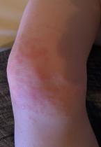 Hand Foot & Mouth Rash Duration