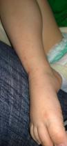 Hand Foot & Mouth Rash Duration