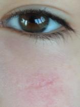 scar on daughter's forehead...should have been stitched and not glued!