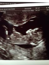 12 week scan