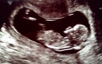 12 week scan