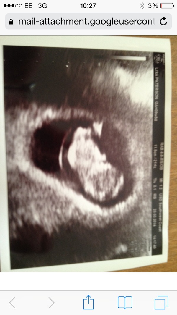 9 week scan pictures?!