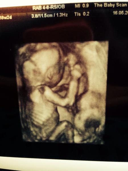 Gender scan this morning!