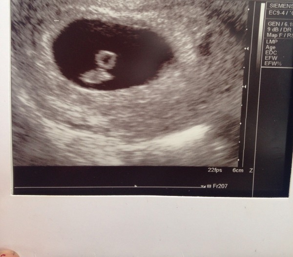 Newbie here (be gentle) and early reassurance scan/paranoia!!