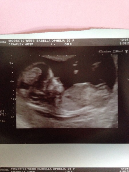 Nuchal fold help